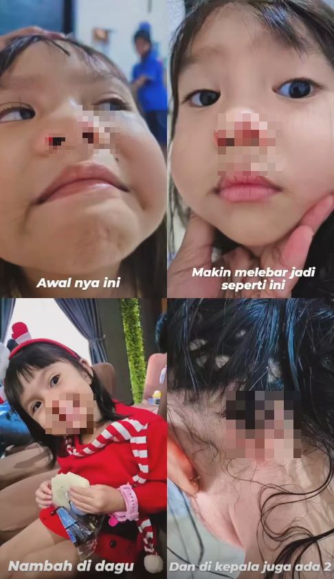 Trauma! Anak Dijangkiti Virus Impetigo Akibat Bermain Di Indoor Playground