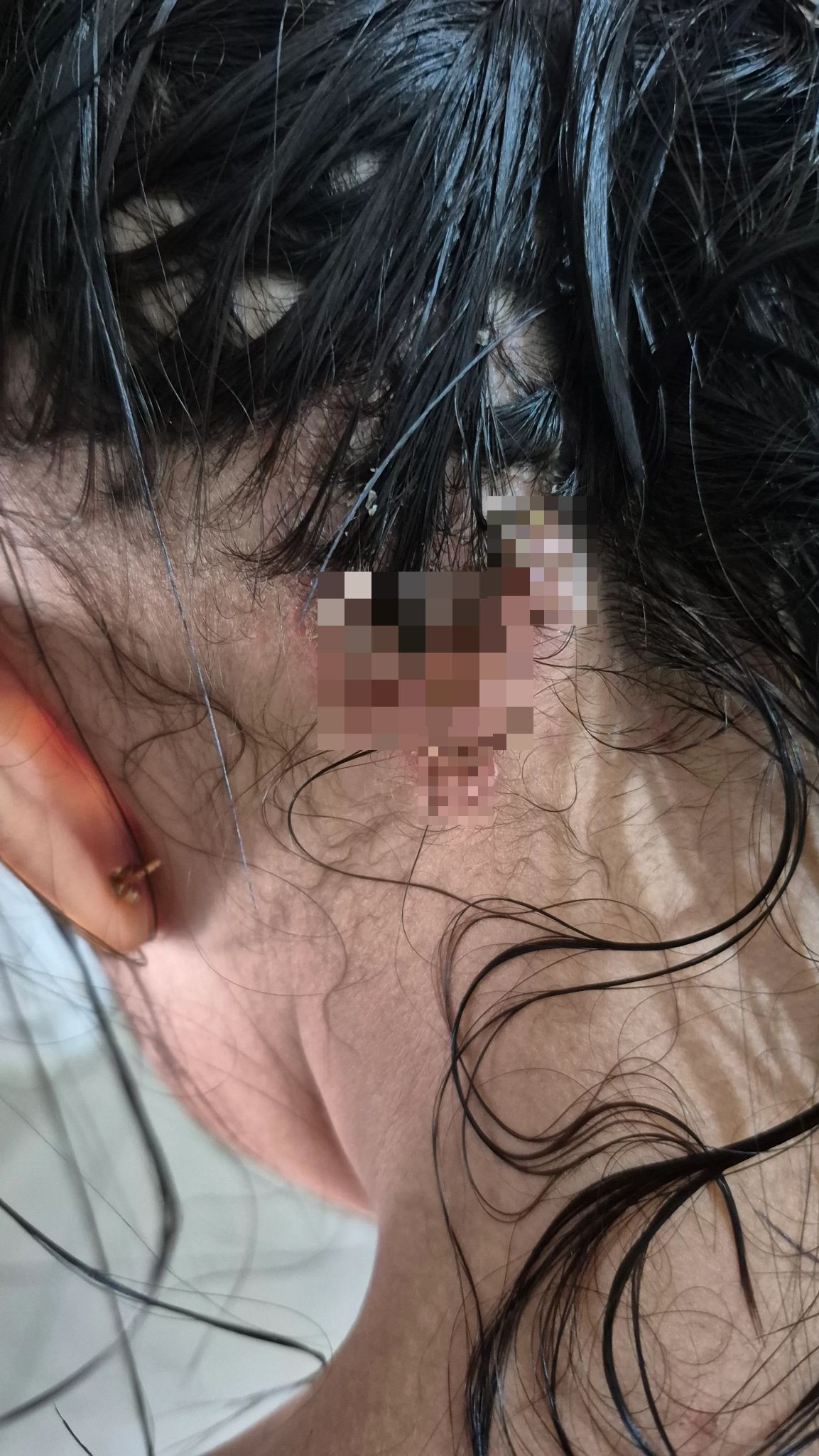 Trauma! Anak Dijangkiti Virus Impetigo Akibat Bermain Di Indoor Playground