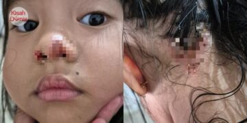 Trauma! Anak Dijangkiti Virus Impetigo Akibat Bermain Di Indoor Playground