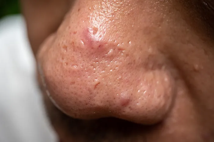 Isteri Picitkan Jerawat Hidung, Suami Meninggal Asbab Komplikasi Pembuluh Otak