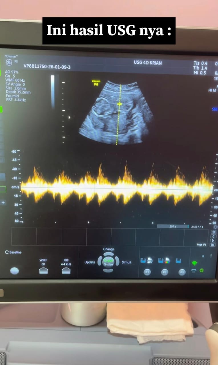 Tertekan Baru Masuk Sekolah Menengah, Anak Tak Datang Haid 3 Bulan Rupanya Hamil