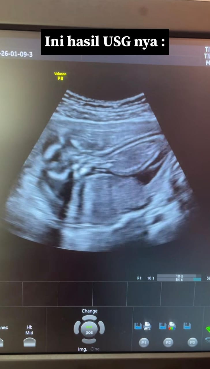 Tertekan Baru Masuk Sekolah Menengah, Anak Tak Datang Haid 3 Bulan Rupanya Hamil