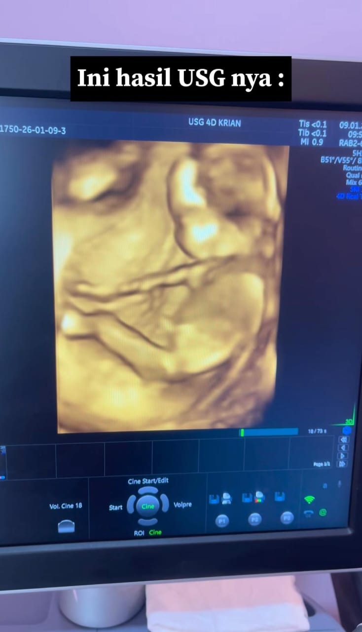 Tertekan Baru Masuk Sekolah Menengah, Anak Tak Datang Haid 3 Bulan Rupanya Hamil