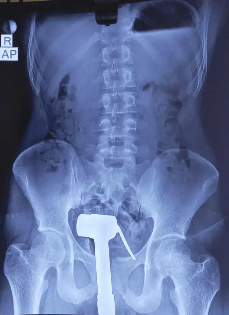 Lelaki Masukkan Paip Bidet Ke ‘Belakang’, Gagal Keluarkan Selepas Cuba Semalaman