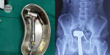 Lelaki Masukkan Paip Bidet Ke ‘Belakang’, Gagal Keluarkan Selepas Cuba Semalaman