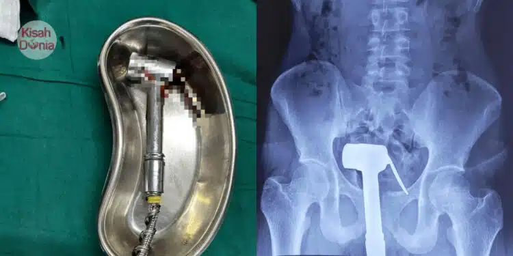 Lelaki Masukkan Paip Bidet Ke ‘Belakang’, Gagal Keluarkan Selepas Cuba Semalaman