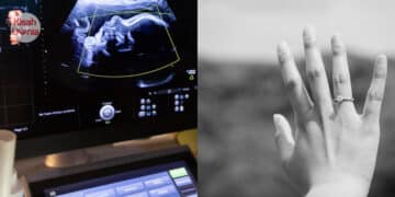 Muncul Kesan Lebam Lepas Akad Nikah, Wanita Disahkan Hipertensi Ditalak Suami