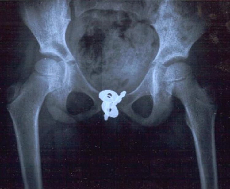 Lelehan Merah Keluar Dari ‘Miss V’, Anak 5 Tahun Rupanya Sorok Kunci Buku Diari