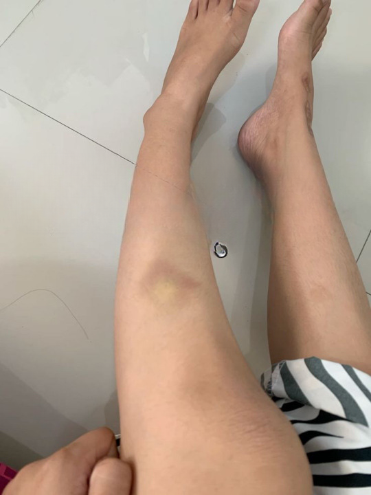 Muncul Kesan Lebam Lepas Akad Nikah, Wanita Disahkan Hipertensi Ditalak Suami