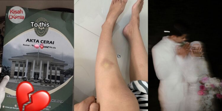 Muncul Kesan Lebam Lepas Akad Nikah, Wanita Disahkan Hipertensi Ditalak Suami