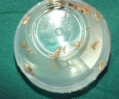 Nenek Sapu Minyak Ke Tali Pusat, Bayi Usia 4 Hari Kena Jangkitan Hingga Berulat