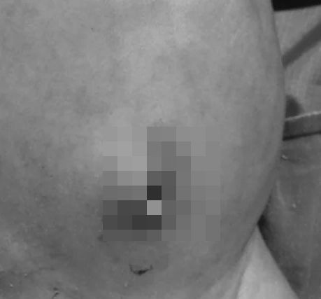 Nenek Sapu Minyak Ke Tali Pusat, Bayi Usia 4 Hari Kena Jangkitan Hingga Berulat