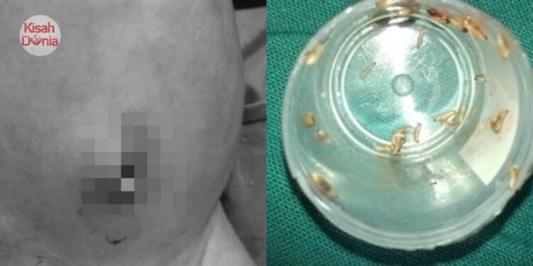 Nenek Sapu Minyak Ke Tali Pusat, Bayi Usia 4 Hari Kena Jangkitan Hingga Berulat