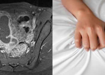 Pelajar 16 Tahun Kerap Projek, Haid 1 Bulan, Keputihan Berbau & Jangkitan Rahim