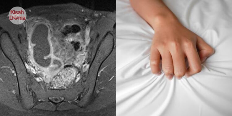 Pelajar 16 Tahun Kerap Projek, Haid 1 Bulan, Keputihan Berbau & Jangkitan Rahim