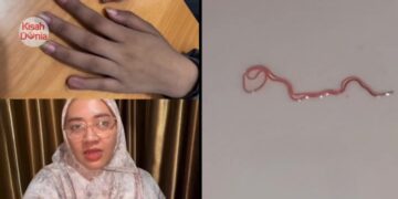 Remaja 17 Tahun Bela Kuku Panjang, Cacing Terkeluar Dari Saluran Kencing