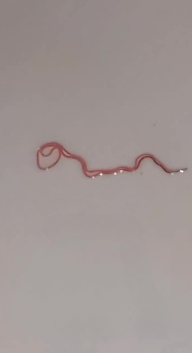 Remaja 17 Tahun Bela Kuku Panjang, Cacing Terkeluar Dari Saluran Kencing