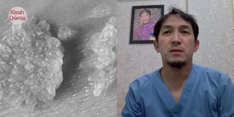 Pelajar Sekolah Dijangkiti Kutil Kelamin Dalam & Luar Miss V Sehingga ‘Belakang’