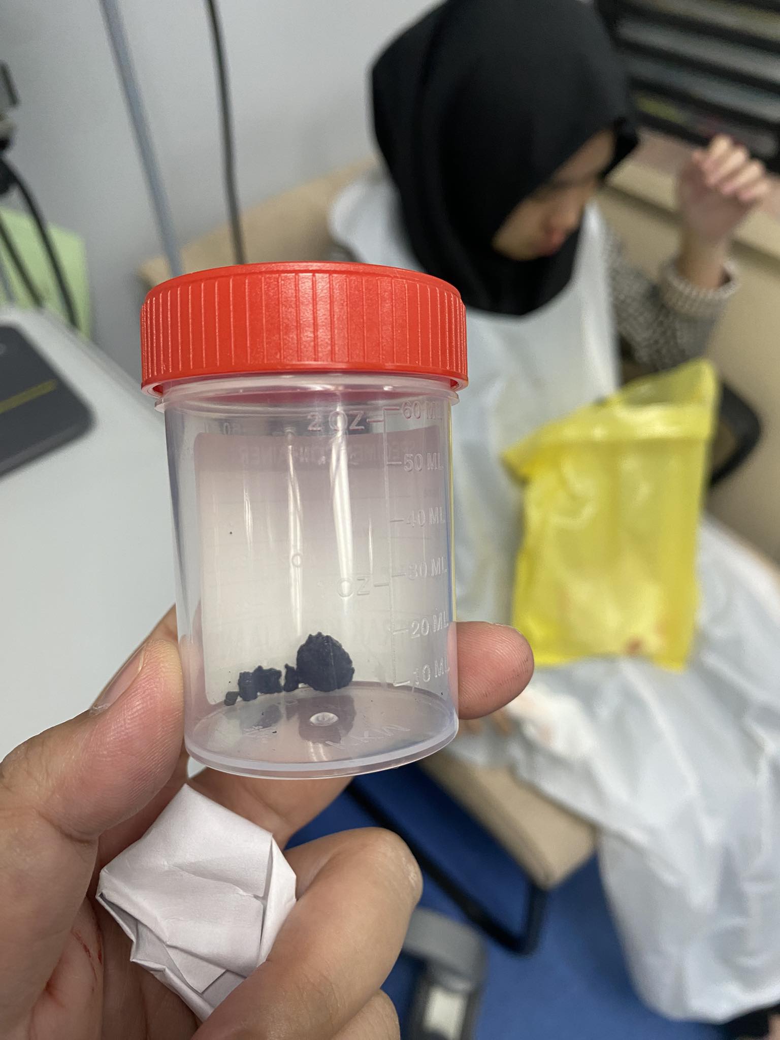 Remaja 16 Tahun Alami Hingus Busuk, Rupanya Masukkan Gula-Gula Masa Usia 7 Tahun