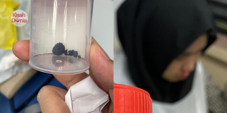 Remaja 16 Tahun Alami Hingus Busuk, Rupanya Masukkan Gula-Gula Masa Usia 7 Tahun