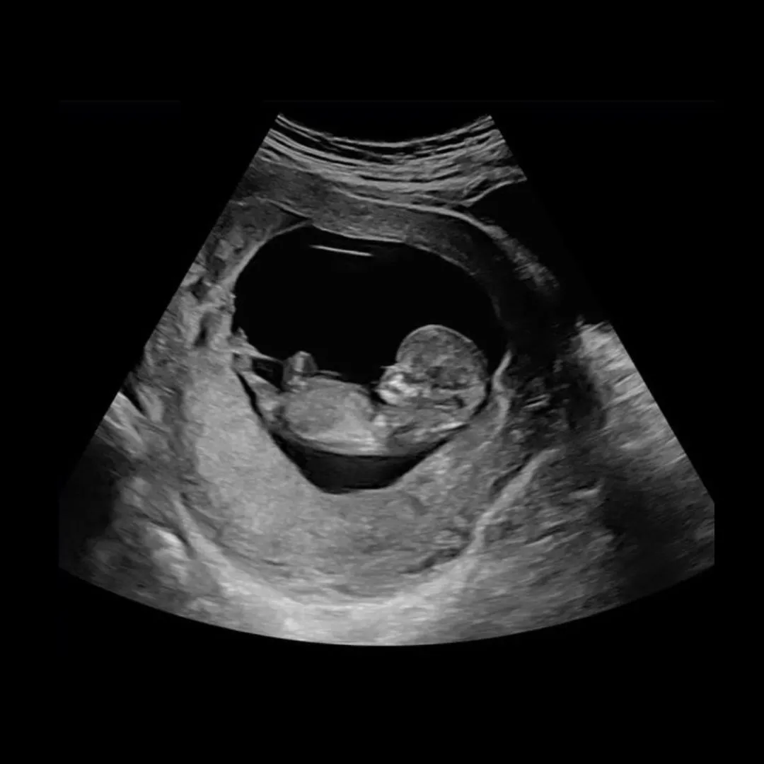 Remaja 15 Tahun Bersalin, 13 Suspek Disiasat, Ujian DNA Bongkar Perbuatan Datuk