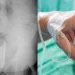 Kaki Sebelah Pendek Akibat Barah, Suami Ubah Suai Selipar Demi Isteri Tunai Haji